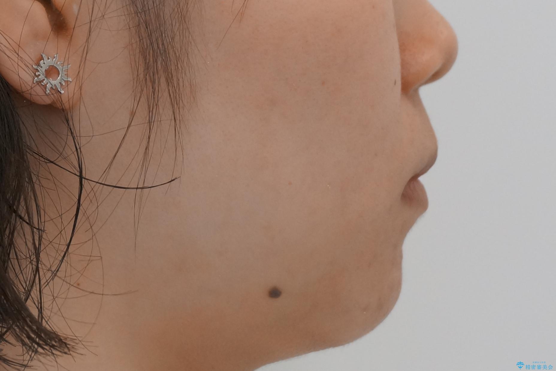 20代女性 出っ歯 口元を引っ込めたいの治療後(顔貌)