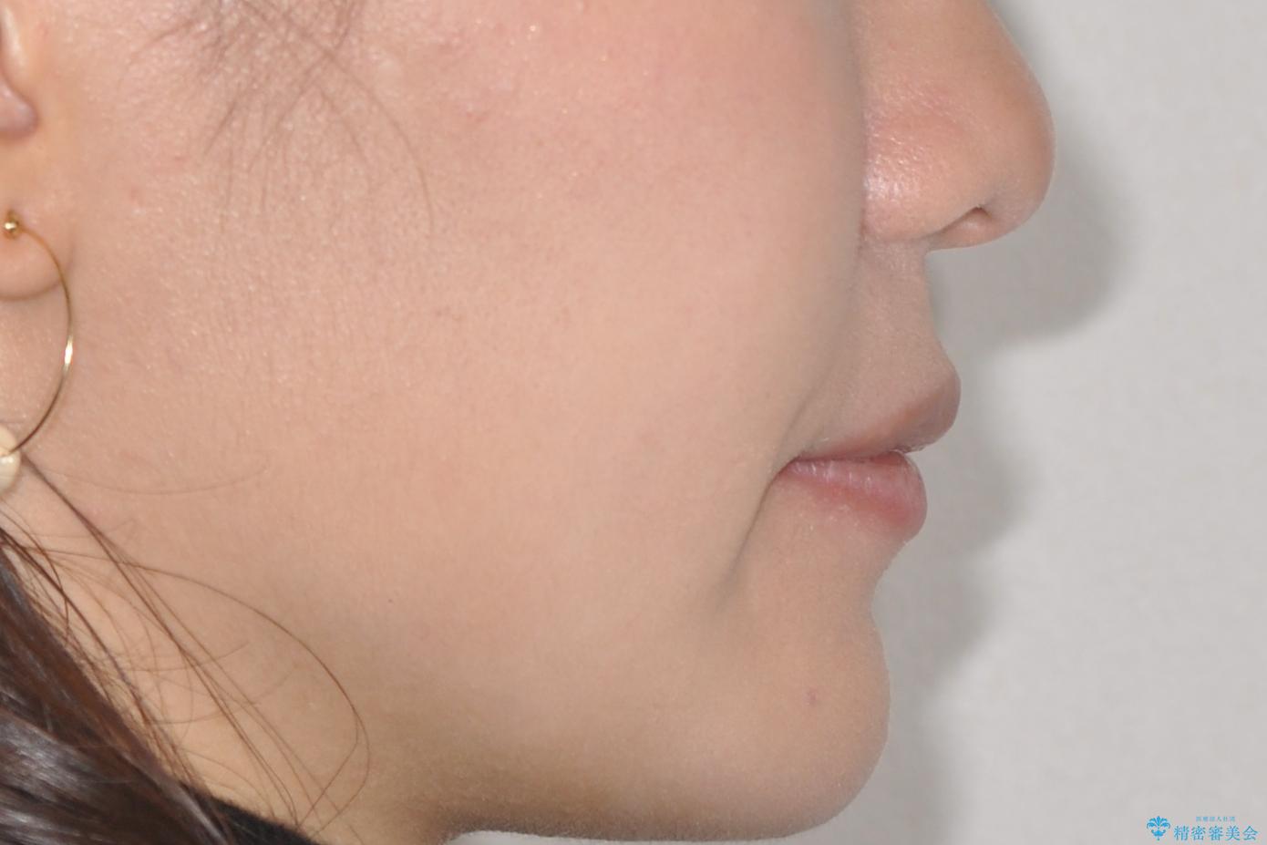 【インビザライン】前歯のガタガタを綺麗にしたい。の治療前(顔貌)