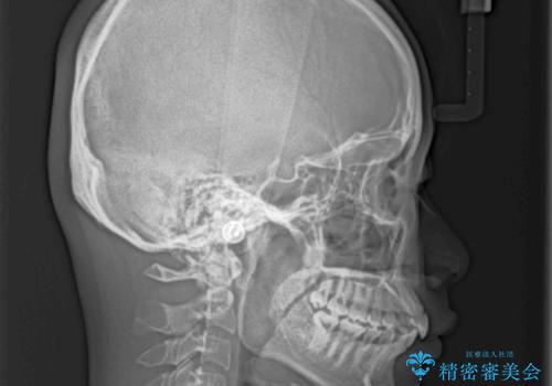 インビザラインによる矯正治療 カリエールディスタライザーを用いた奥歯の咬み合わせ改善の治療前