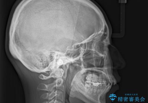スッキリとした口元へ 出っ歯の抜歯矯正の治療前