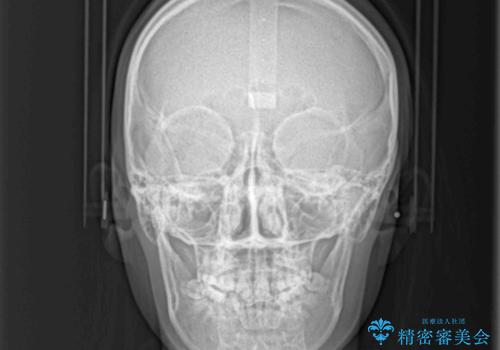 前後に重なった前歯 ワイヤー装置と急速拡大装置を併用したインビザライン矯正の治療前
