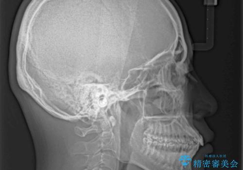 口が閉じにくい インビザラインによる矯正治療の治療前