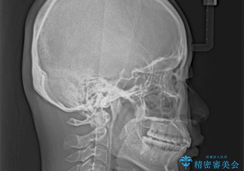 インビザラインによる矯正治療 カリエールディスタライザーを用いた奥歯の咬み合わせ改善の治療後