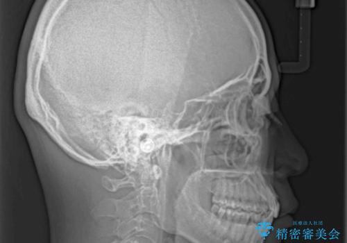 口が閉じにくい インビザラインによる矯正治療の治療後