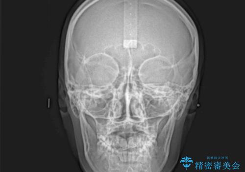 前後に重なった前歯 ワイヤー装置と急速拡大装置を併用したインビザライン矯正の治療後