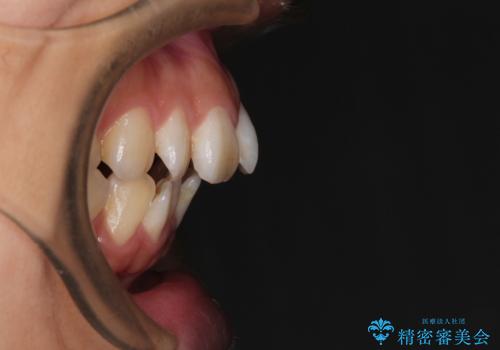 スッキリとした口元へ　出っ歯の抜歯矯正の治療前