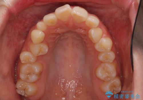 狭い上顎骨を拡大 急速拡大装置を併用したインビザライン矯正の治療前