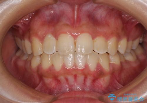 前後に重なった前歯 ワイヤー装置と急速拡大装置を併用したインビザライン矯正の症例 治療後