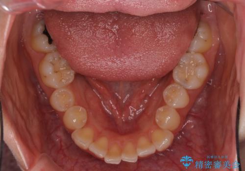 狭い上顎骨を拡大 急速拡大装置を併用したインビザライン矯正の治療前