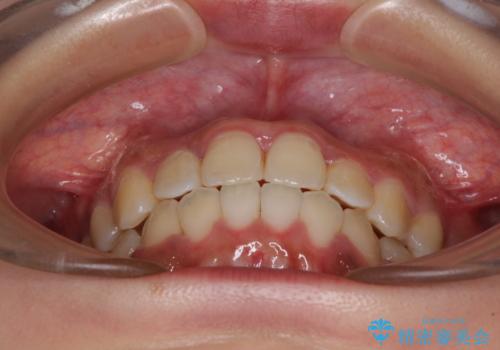 前後に重なった前歯 ワイヤー装置と急速拡大装置を併用したインビザライン矯正の治療後