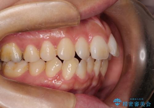 スッキリとした口元へ 出っ歯の抜歯矯正の治療前