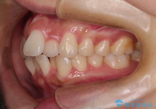 スッキリとした口元へ 出っ歯の抜歯矯正の治療前