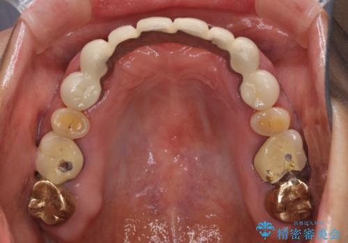 出血が止まらない インプラント補綴を用いた歯周病治療の治療前