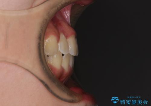 前後に重なった前歯 ワイヤー装置と急速拡大装置を併用したインビザライン矯正の治療後