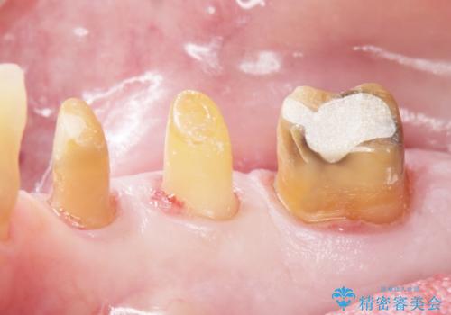 骨を再生させて歯周病を治す 再生療法 50代男性の治療後