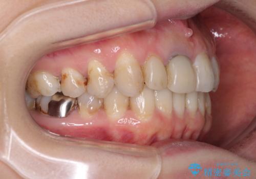 歯並びと目立つ金属を治したい　総合歯科治療の治療中