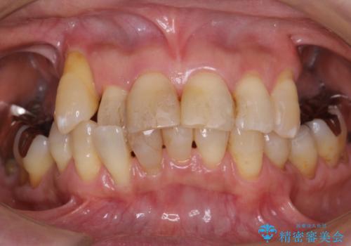 奥歯がないまま過ごしていたら前歯もぐらぐらしてきた　60代女性の症例 治療前