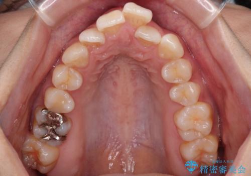 スッキリとした口元へ 出っ歯の抜歯矯正の治療前