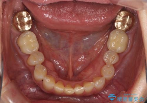 出血が止まらない インプラント補綴を用いた歯周病治療の治療前