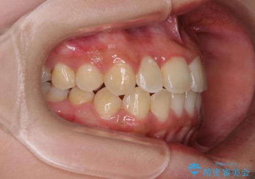前後に重なった前歯 ワイヤー装置と急速拡大装置を併用したインビザライン矯正の治療後