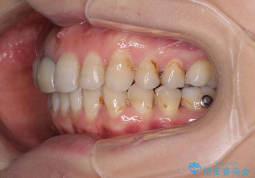 歯並びと目立つ金属を治したい　総合歯科治療の治療中