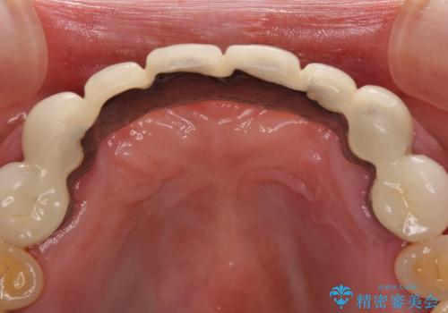 出血が止まらない インプラント補綴を用いた歯周病治療の治療前