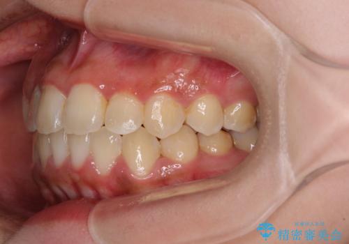前後に重なった前歯 ワイヤー装置と急速拡大装置を併用したインビザライン矯正の治療後