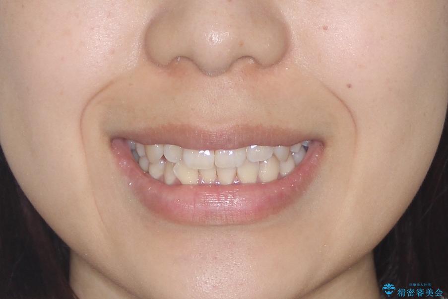 【インビザライン】前歯の凸凹をなおしたいの治療前(顔貌)