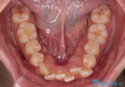 スッキリとした口元へ 出っ歯の抜歯矯正の治療前