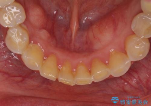 出血が止まらない インプラント補綴を用いた歯周病治療の治療前