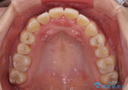 前後に重なった前歯 ワイヤー装置と急速拡大装置を併用したインビザライン矯正の治療後