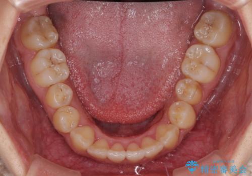 前後に重なった前歯 ワイヤー装置と急速拡大装置を併用したインビザライン矯正の治療後