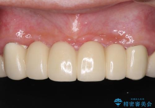 出血が止まらない インプラント補綴を用いた歯周病治療の治療前