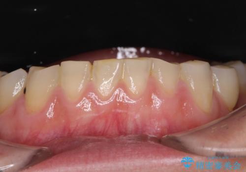 出血が止まらない インプラント補綴を用いた歯周病治療の治療前