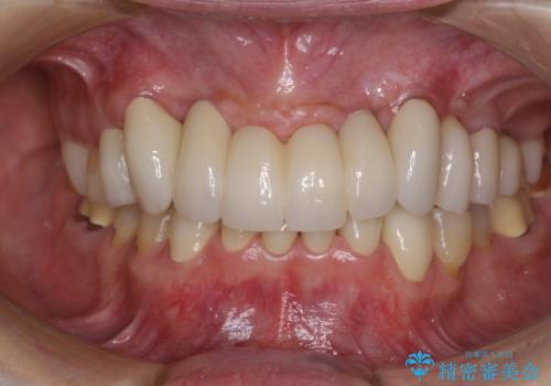 出血が止まらない インプラント補綴を用いた歯周病治療の症例 治療後
