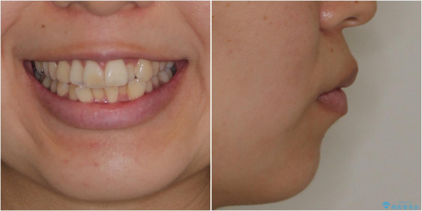 スッキリとした口元へ 出っ歯の抜歯矯正の治療前(顔貌)