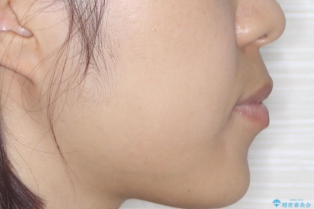 【インビザライン】前歯の凸凹をなおしたいの治療前(顔貌)