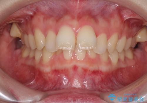 費用を抑えた抜歯矯正　口元の突出感の改善の症例 治療前
