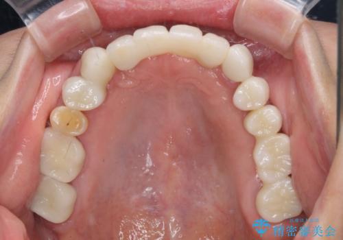出血が止まらない インプラント補綴を用いた歯周病治療の治療後