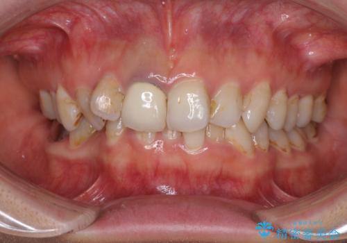 歯並びと目立つ金属を治したい　総合歯科治療の症例 治療前