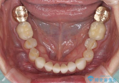 出血が止まらない インプラント補綴を用いた歯周病治療の治療後