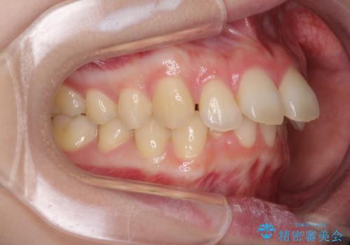 費用を抑えた抜歯矯正　口元の突出感の改善の治療前