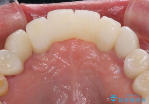 出血が止まらない インプラント補綴を用いた歯周病治療の治療後