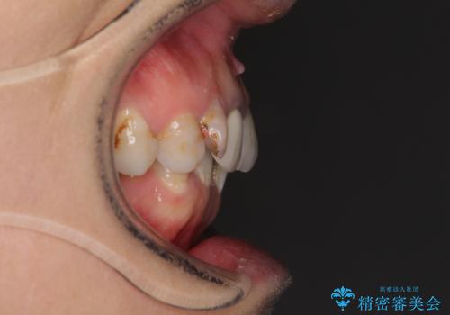 歯並びと目立つ金属を治したい　総合歯科治療の治療前