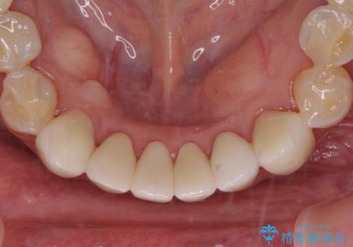 出血が止まらない インプラント補綴を用いた歯周病治療の治療後