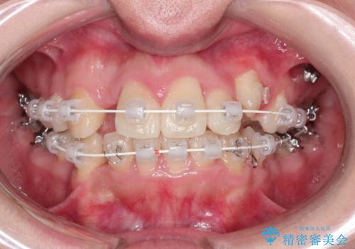 犬歯が変な位置にある 抜歯矯正により正しい位置への治療中