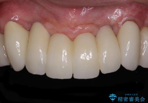 出血が止まらない インプラント補綴を用いた歯周病治療の治療後