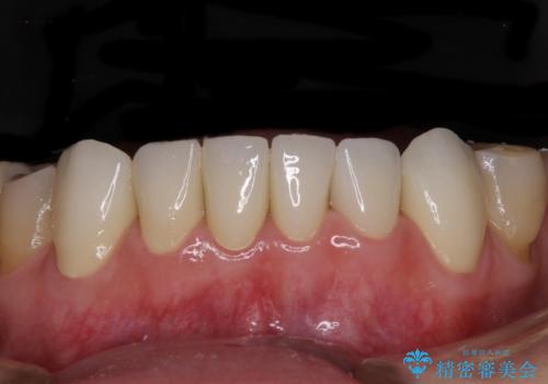 出血が止まらない インプラント補綴を用いた歯周病治療の治療後