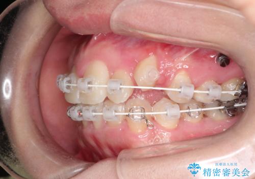 犬歯が変な位置にある　抜歯矯正により正しい位置への治療中