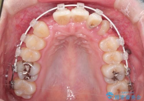 犬歯が変な位置にある 抜歯矯正により正しい位置への治療中